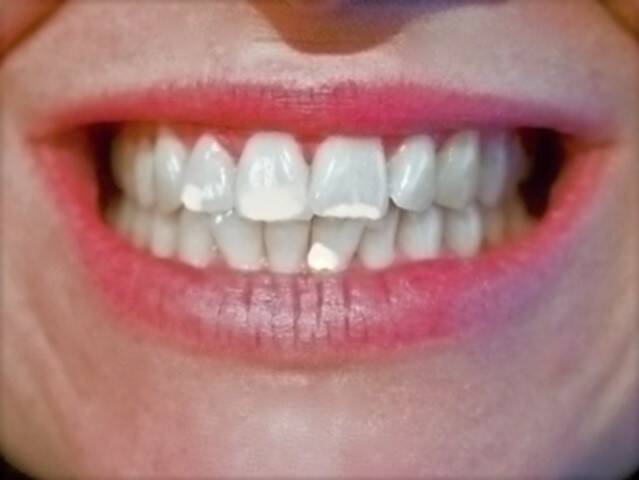 Biele škvrny na zuboch a ich príčiny? Ako si pomôcť a fľaky odstrániť?