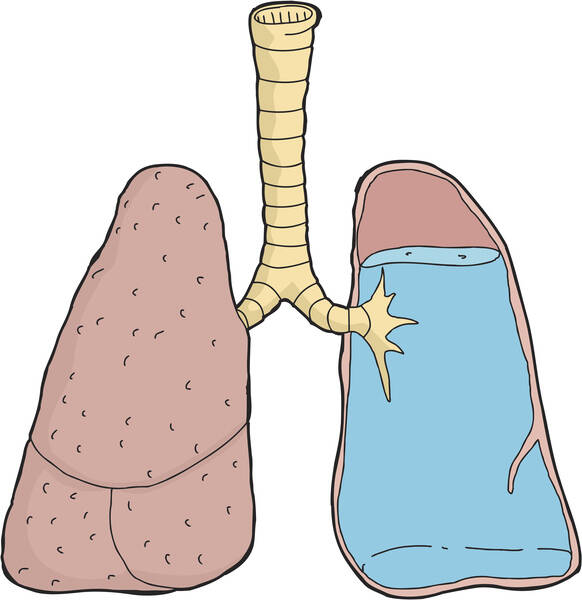 Opuch pľúc: Prečo vzniká edém pľúc? Je častou príčinou smrti?