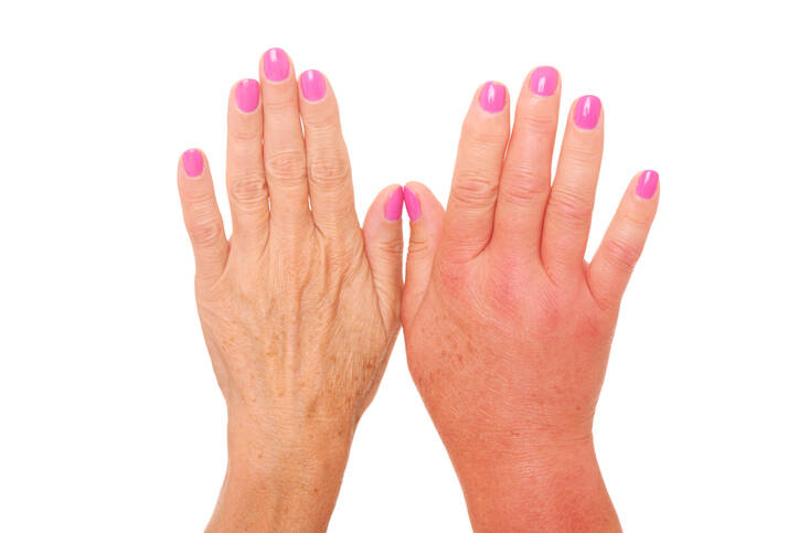 Opuchnuté prsty: Prečo nám prsty opúchajú, aké ochorenia to značí?