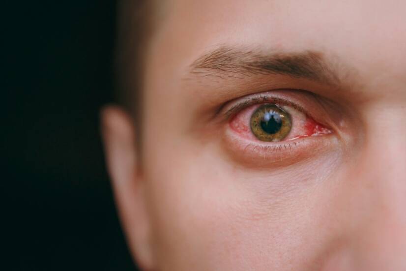 Začervenanie očných spojoviek: Aké má príčiny? (+ príznaky)