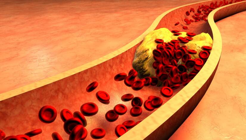 Zvýšený cholesterol: čo je to LDL (zlý) a HDL (dobrý)? Aké sú príčiny?