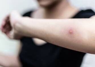 Kožný absces: Čo je, aké má príčiny a príznaky infekcia kože?
