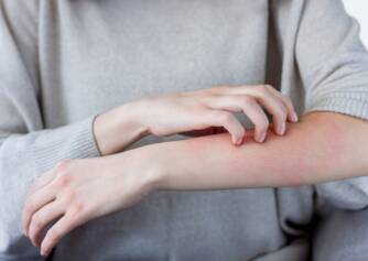 Ekzém alebo psoriáza? Rozdiely a príznaky kožných ochorení