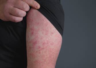 Erysipel: aké sú príčiny vzniku kožnej infekcie? + Príznaky a liečba