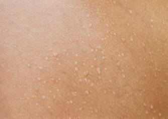 Mokvanie kože pre zápal, dermatitídu či ekzém? Spoznajte príčiny