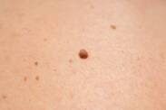 Čo je fibróm na koži, ako vyzerá, aké má príznaky? Príčiny vzniku