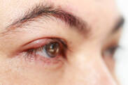 Jačmenné zrno, jačmeň na oku: Príčiny, príznaky /Hordeolum, chalazion