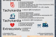 Infografika: Aké druhy arytmií poznáme + ukážky EKG záznamov