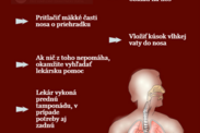 Infografika: Čo robiť pri krvácaní z nosa?