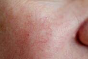 Rozšírené červené žilky na tvári: aká je účinná pomoc a prevencia?