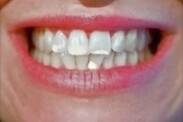 Biele škvrny na zuboch a ich príčiny? Ako si pomôcť a fľaky odstrániť?