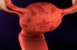 Ako spolu súvisí endometrióza a neplodnosť? + Ostatné príznaky a zdravotné ťažkosti